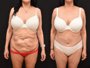Abdominoplasty to Improve Abdominal Contour
