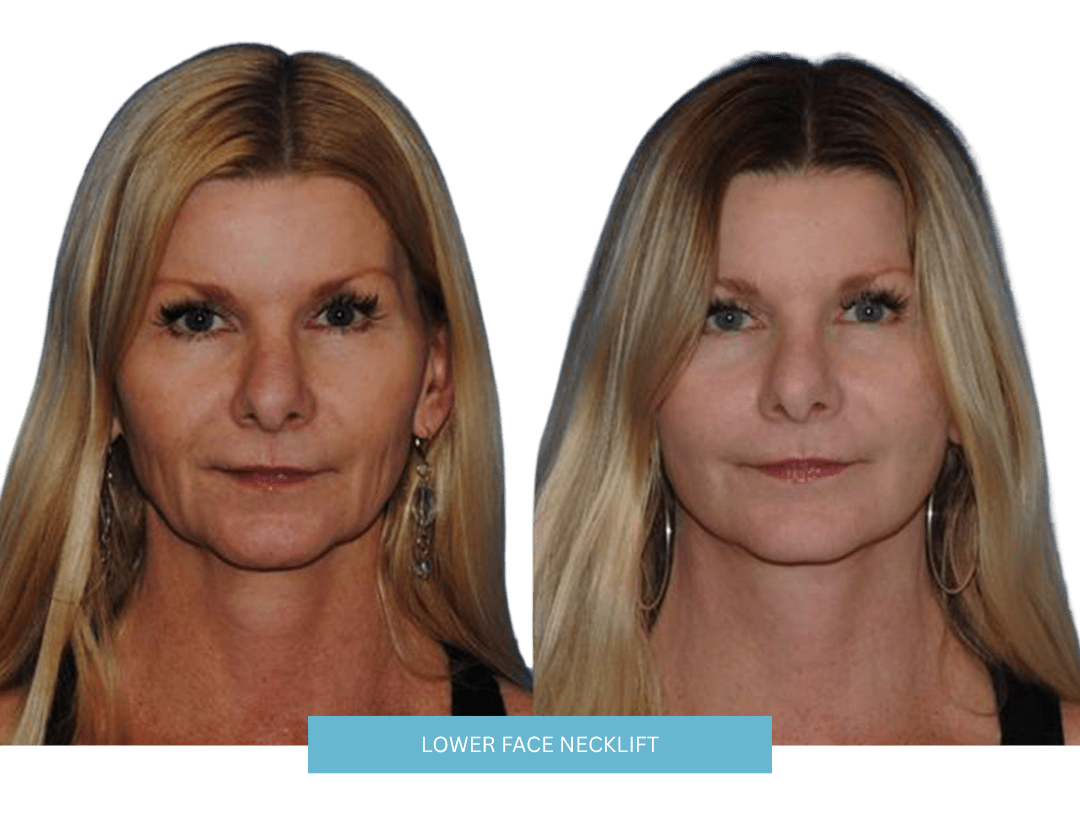 LOWER FACE NECKLIFT (2)
