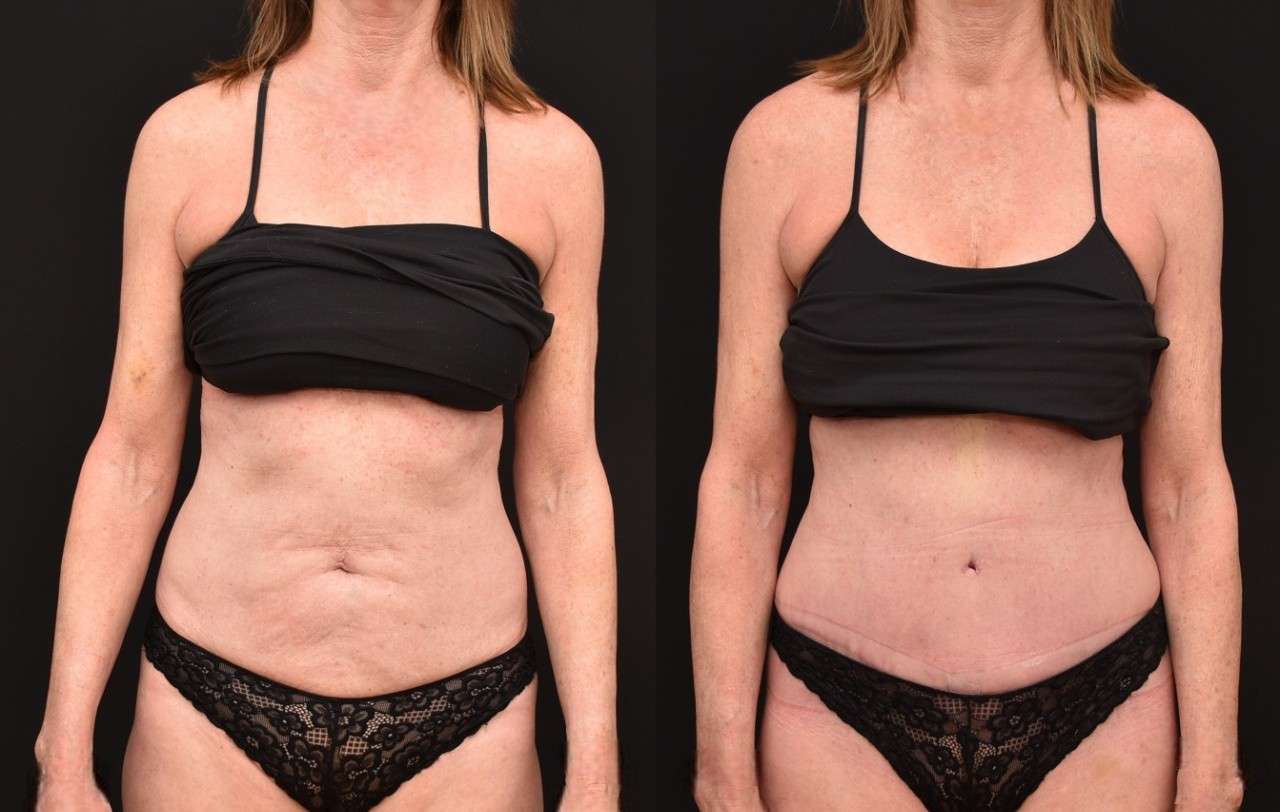 Abdominoplasty to Remove Excess Skin