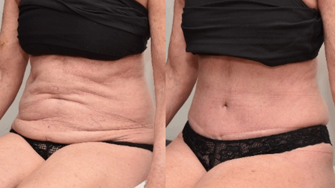 Abdominoplasty to Improve Skin Contour After Liposuction