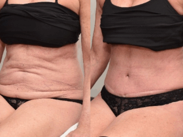 Abdominoplasty to Improve Skin Contour After Liposuction