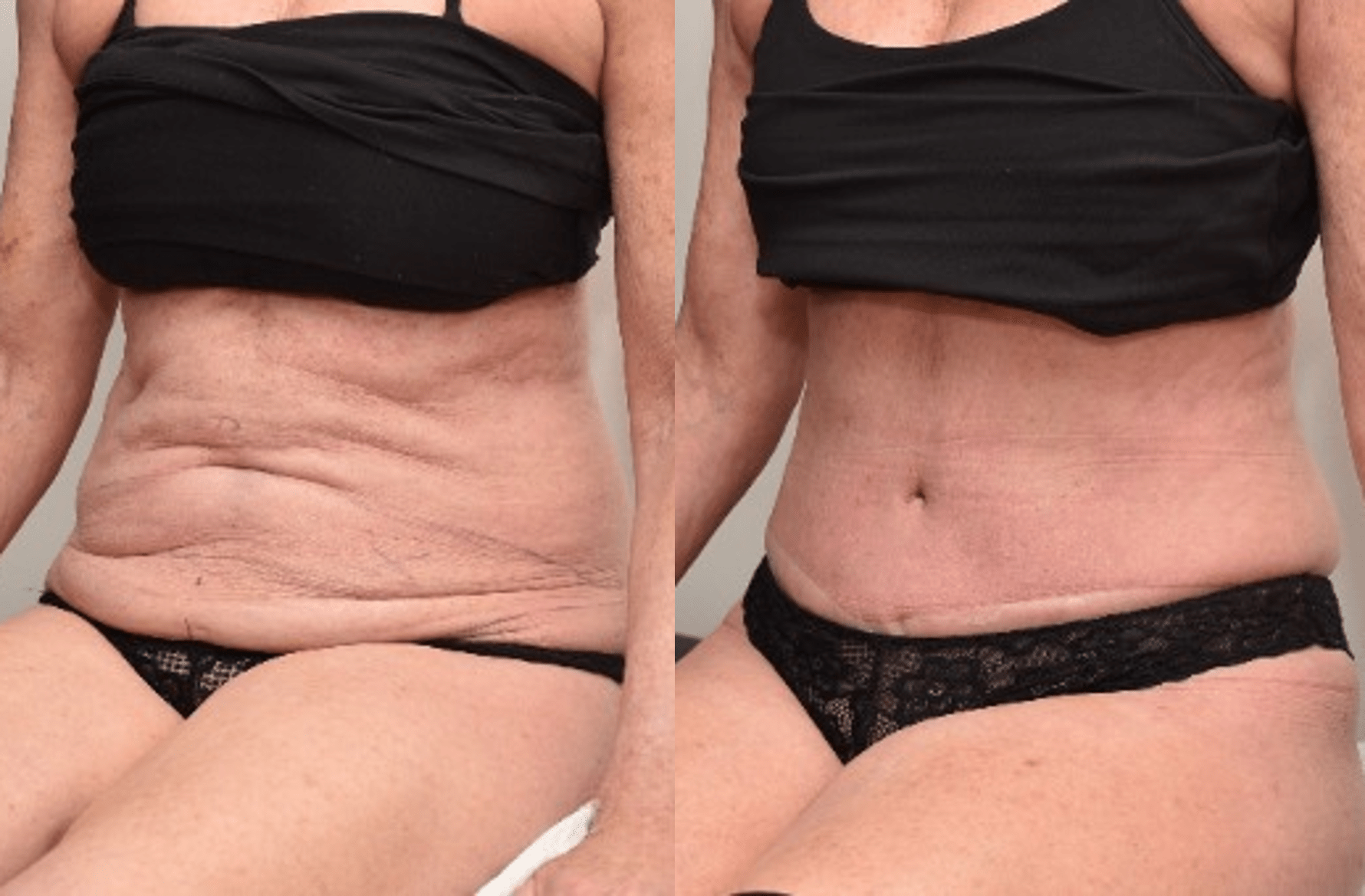 Abdominoplasty after Liposuction