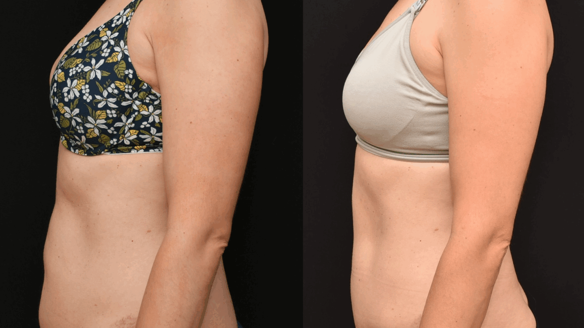 Abdominoplasty to Improve the Lower Abdominal Contour