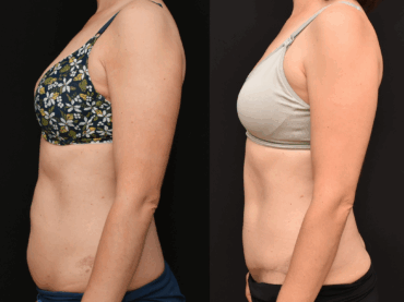 Abdominoplasty to Improve the Lower Abdominal Contour