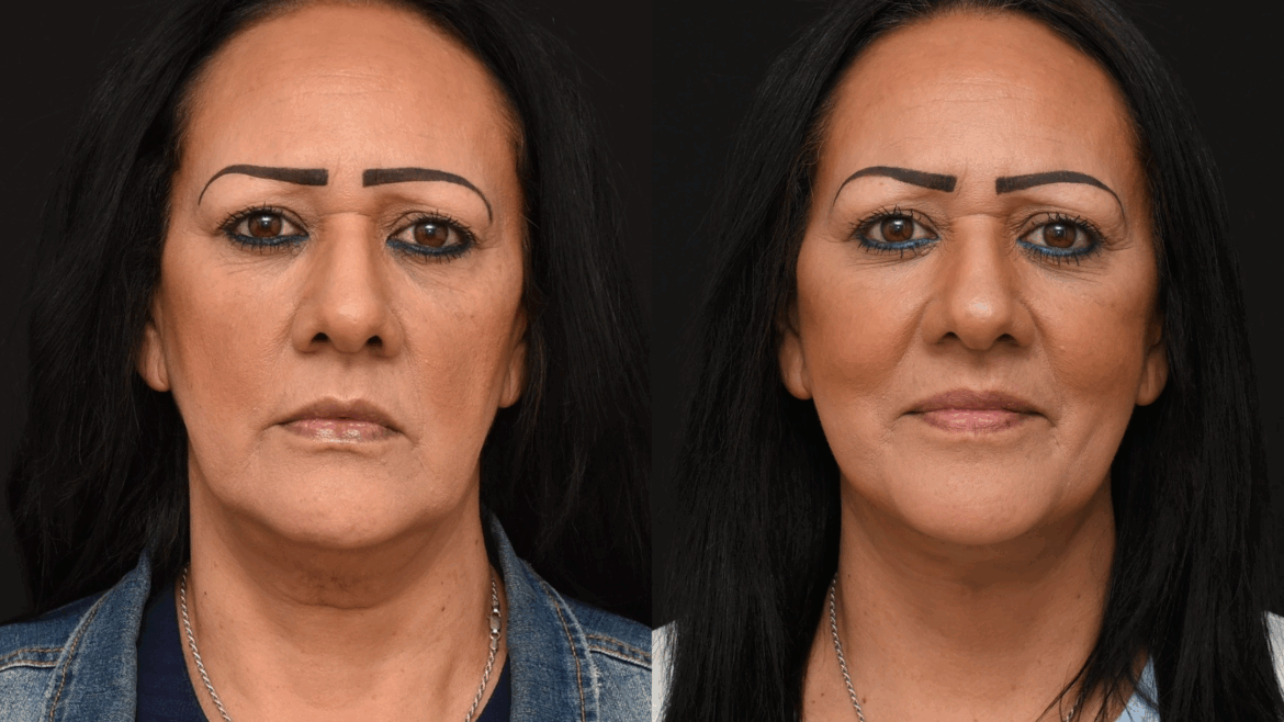 Deep Plane Lower Face and Neck lift