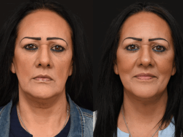 Deep Plane Lower Face and Neck lift