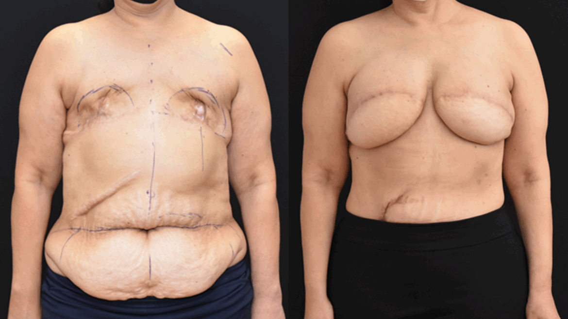 October is Breast Cancer Awareness Month: Bilateral DIEP Breast Reconstruction