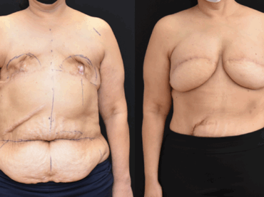 October is Breast Cancer Awareness Month: Bilateral DIEP Breast Reconstruction
