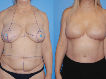Breast Cancer Awareness Month DIEP Flap Reconstruction