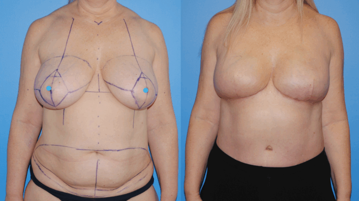 Breast Cancer Awareness Month DIEP Flap Reconstruction