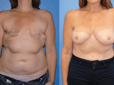 Breast Cancer Awareness Month. Bilateral DIEP Flap Breast Reconstruction