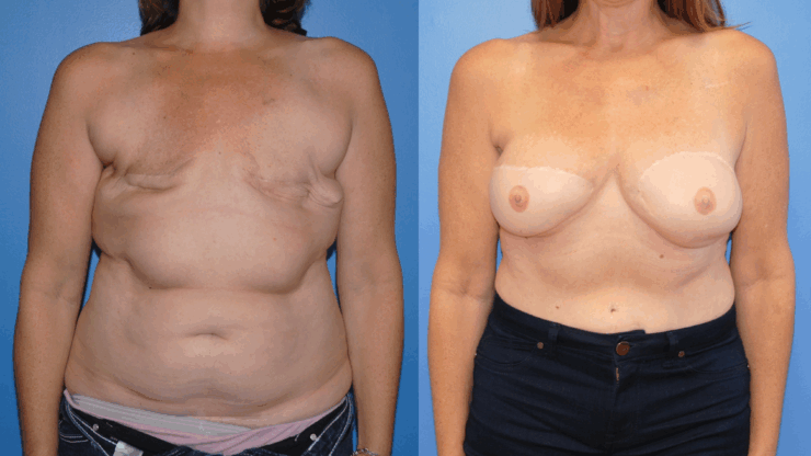 Breast Cancer Awareness Month. Bilateral DIEP Flap Breast Reconstruction