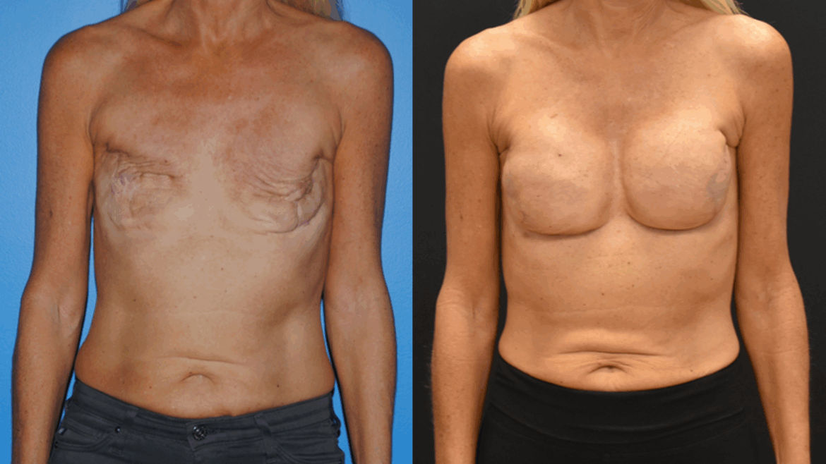 Breast Cancer Awareness Month: Implant Reconstruction in a Hostile Environment