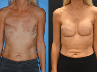 Breast Cancer Awareness Month: Implant Reconstruction in a Hostile Environment