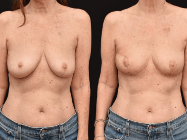 Breast Cancer Awareness Month Lumpectomy Breast Reconstruction
