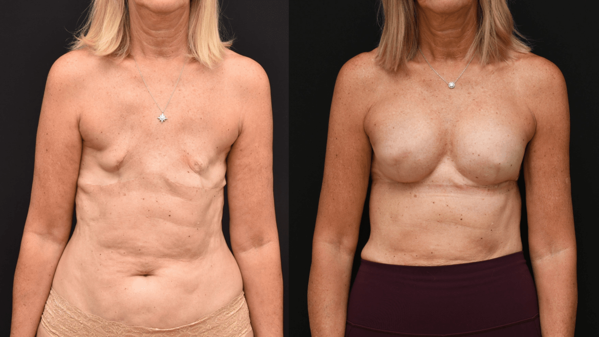 Delayed Insertion of Mammary Prosthesis post Bilateral Mastectomy.