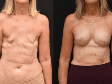 Delayed Insertion of Mammary Prosthesis post Bilateral Mastectomy.