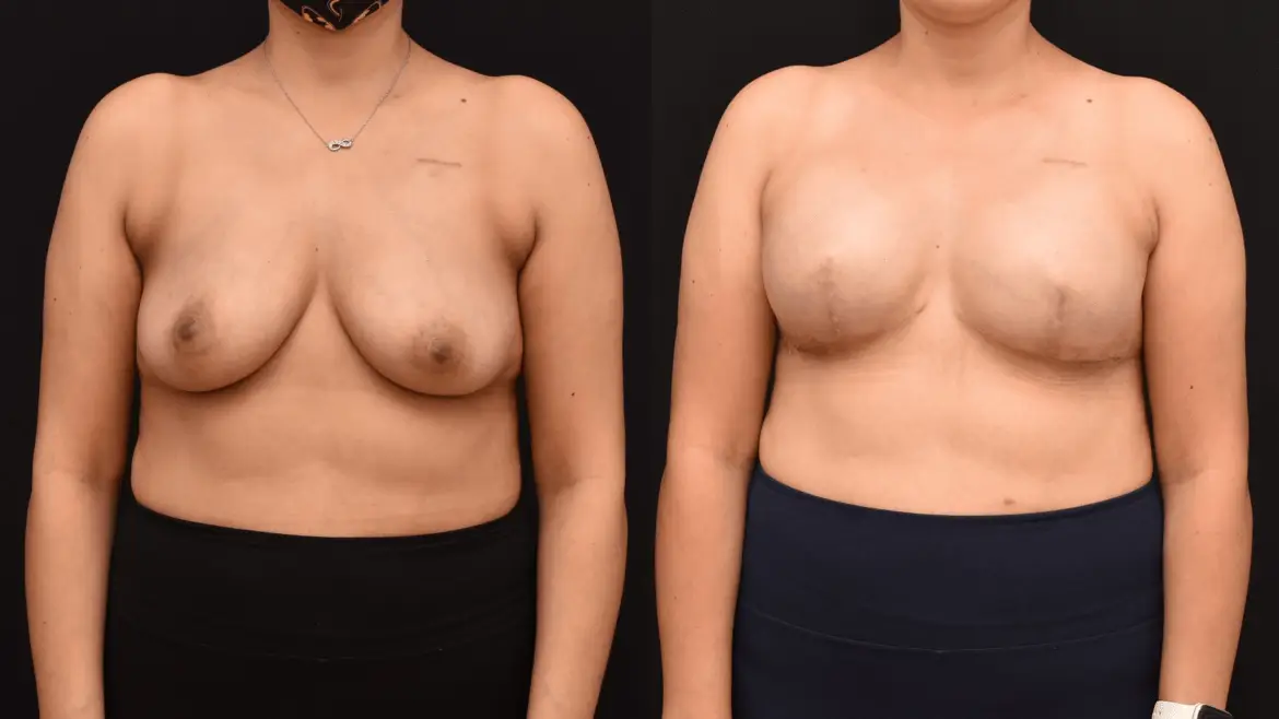 Bilateral Mastectomy Breast Reconstruction