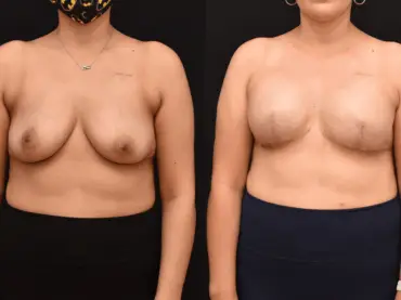 Bilateral Mastectomy Breast Reconstruction
