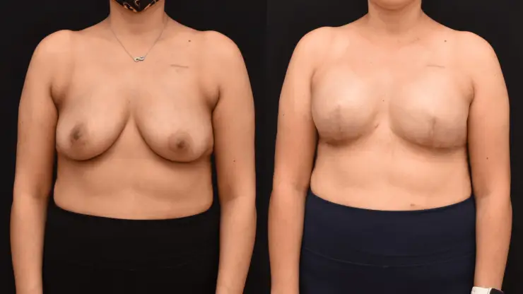 Bilateral Mastectomy Breast Reconstruction