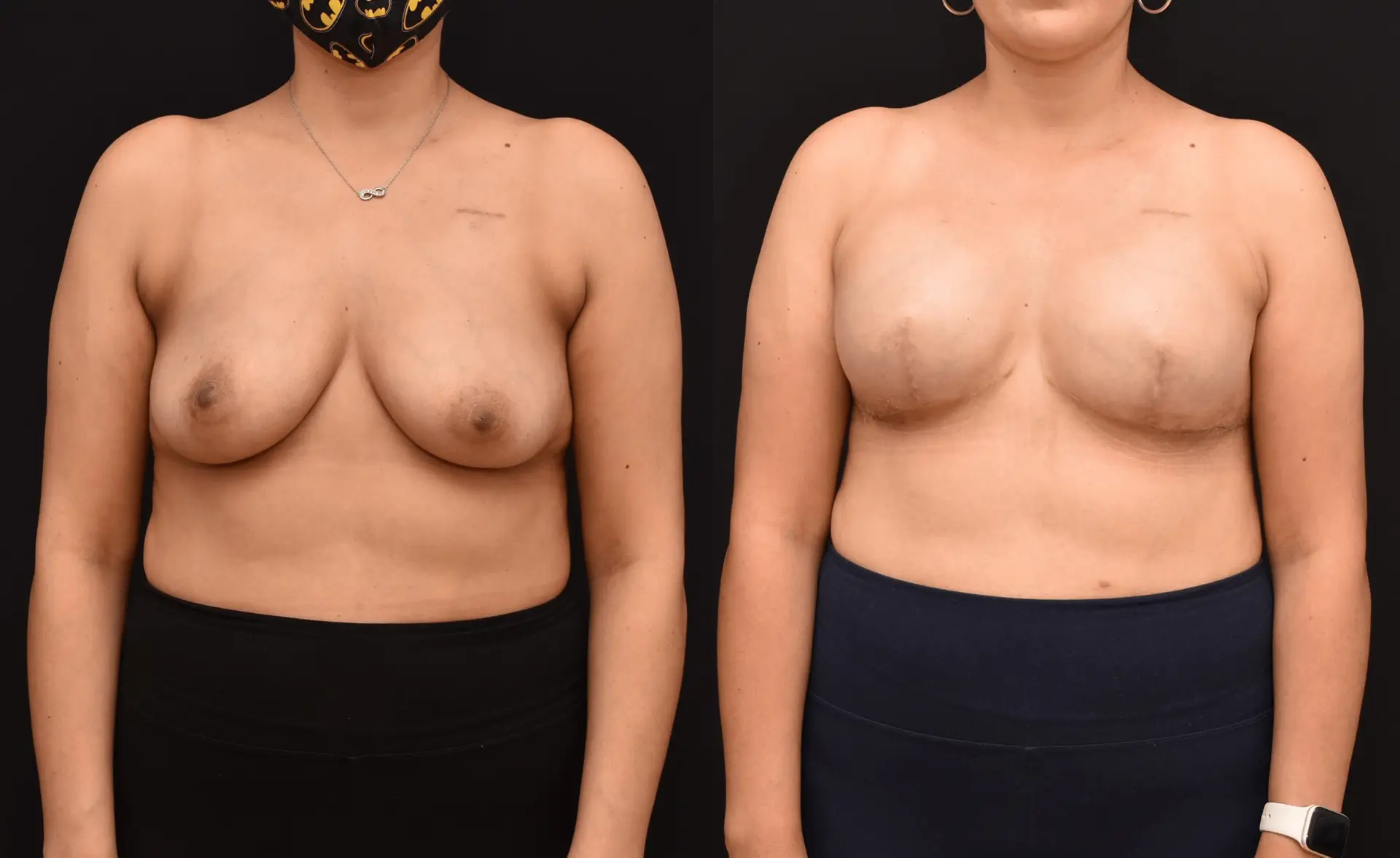 Bilateral Mastectomy Reconstruction