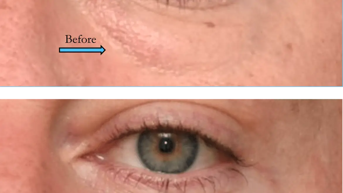 Lower Blepharoplasty Surgery