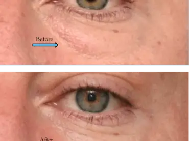 Lower Blepharoplasty Surgery