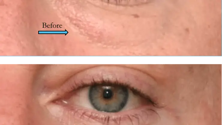 Lower Blepharoplasty Surgery