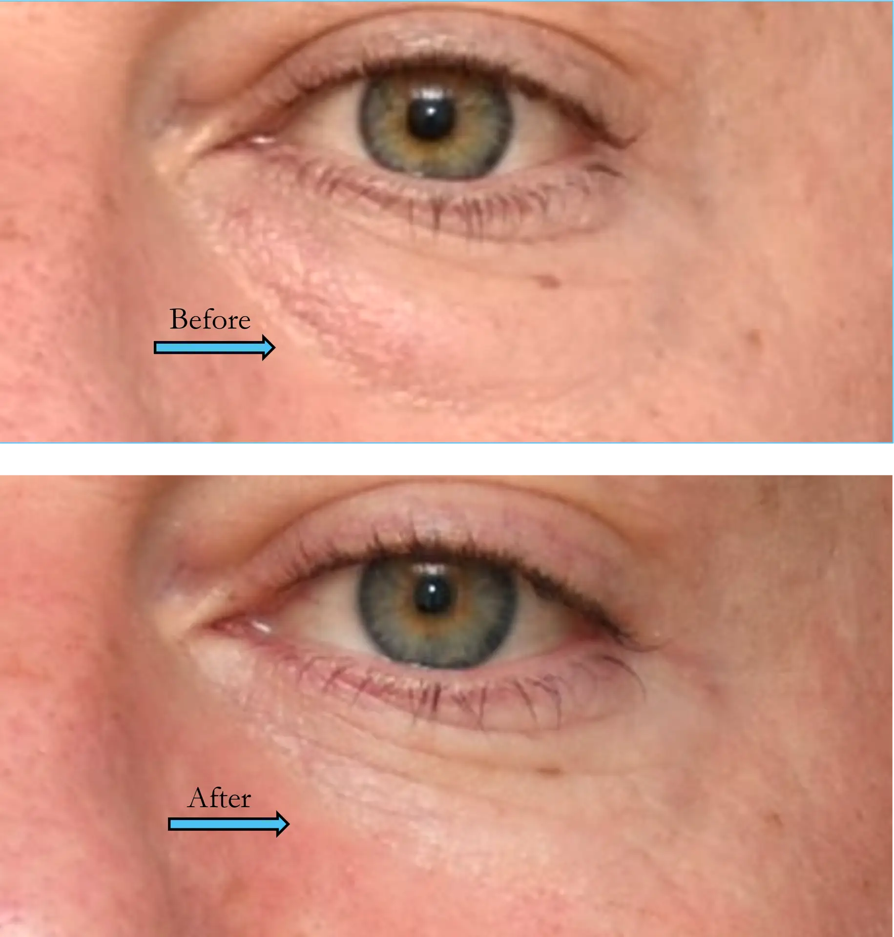 Lower Lid Blepharoplasty