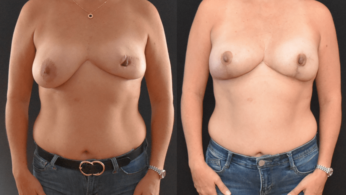 Breast Asymmetry
