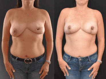 Breast Asymmetry