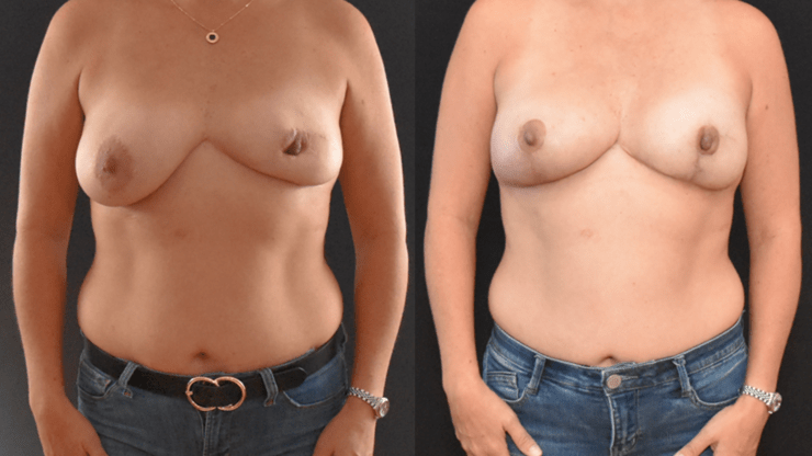 Breast Asymmetry