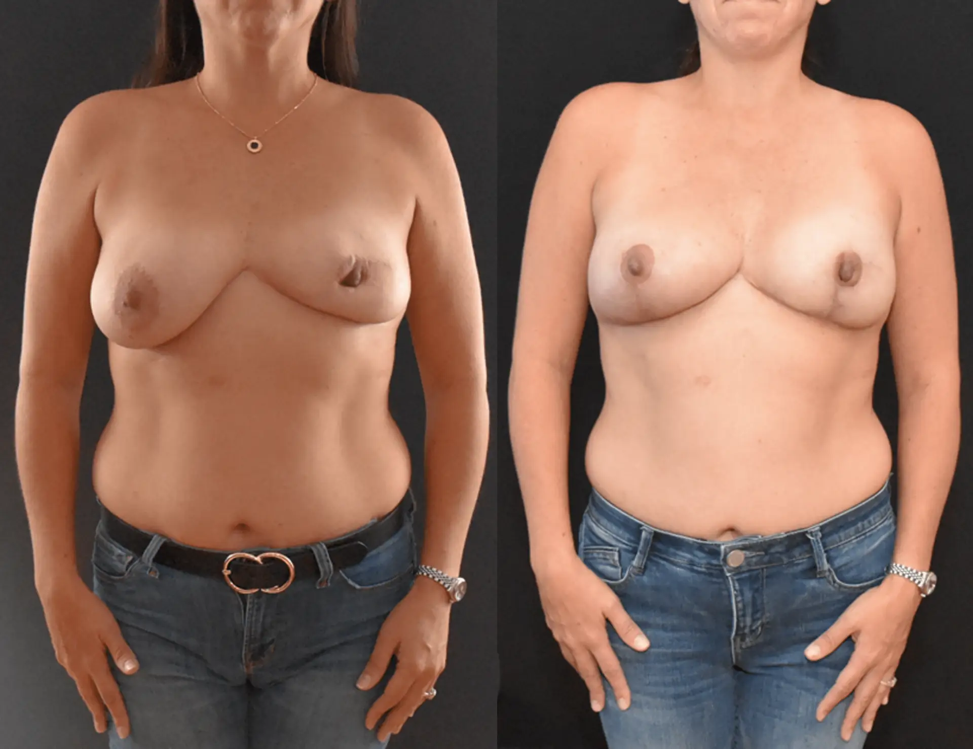 Breast Asymmetry