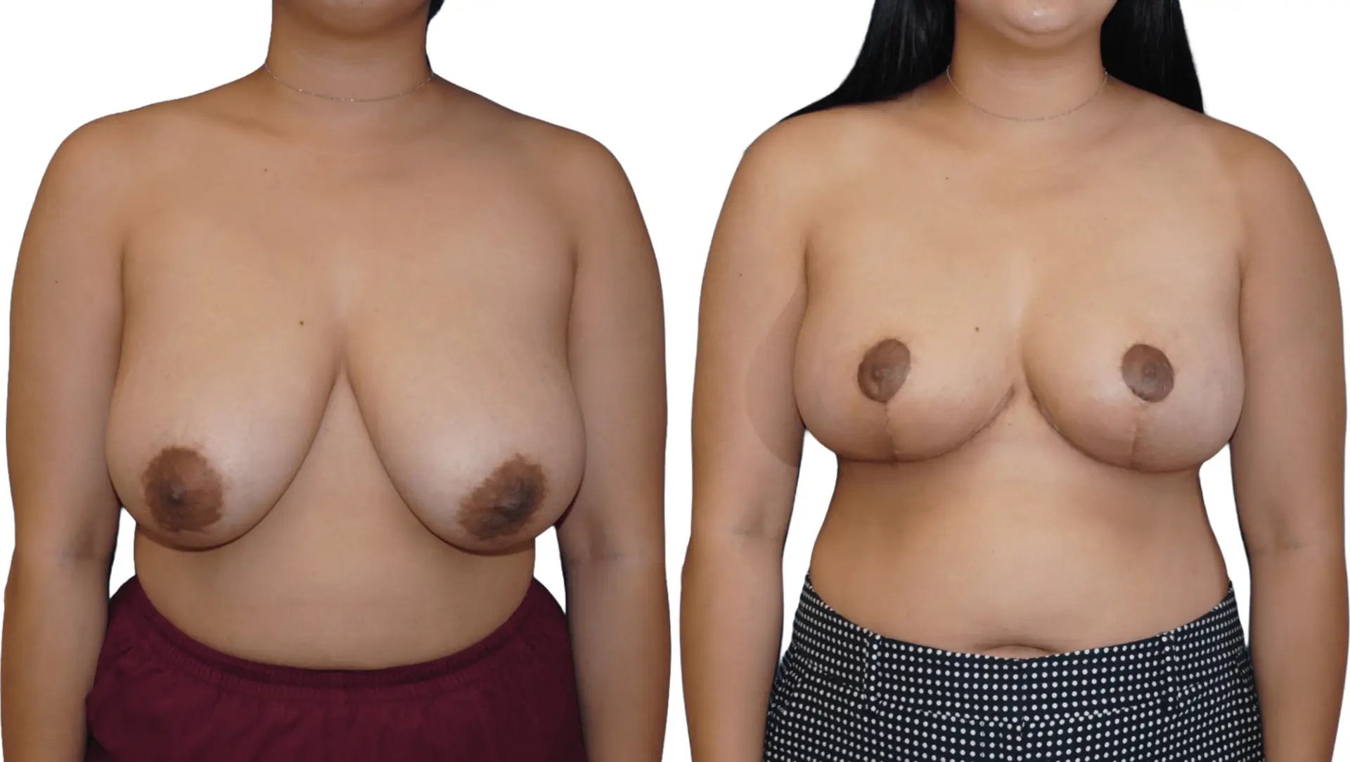 Breast Reduction Surgery