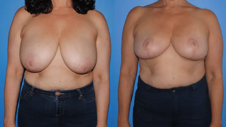 Breast Reduction Surgery
