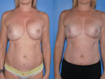 Downsize of Implant, Selective Capsulectomy, Mastopexy