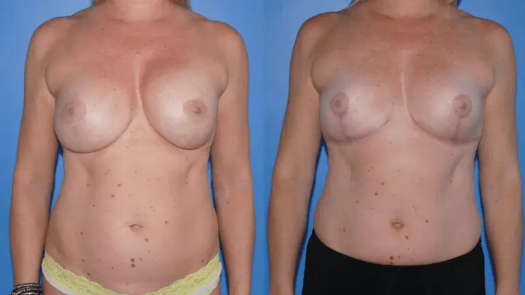 Downsize of Implant, Selective Capsulectomy, Mastopexy