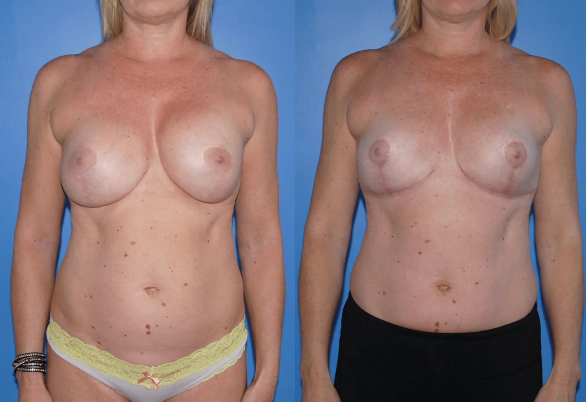 Implant Removal & Replacement Mastopexy