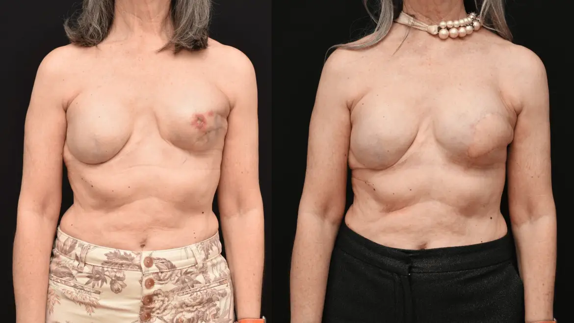 Latissimus Dorsi Flap Breast Reconstruction