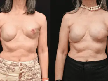Latissimus Dorsi Flap Breast Reconstruction