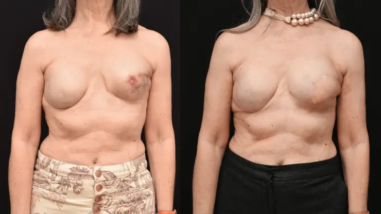 Latissimus Dorsi Flap Breast Reconstruction