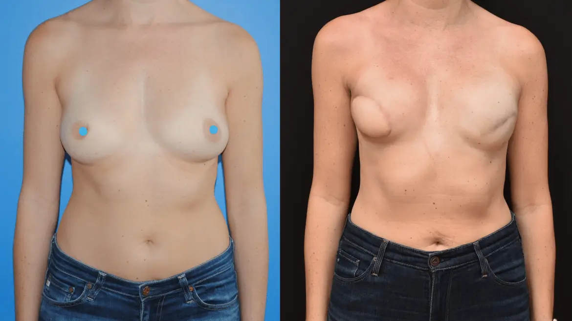 Latissimus Dorsi Myocutaneous Flap Reconstruction and Improved Mastectomy Skin