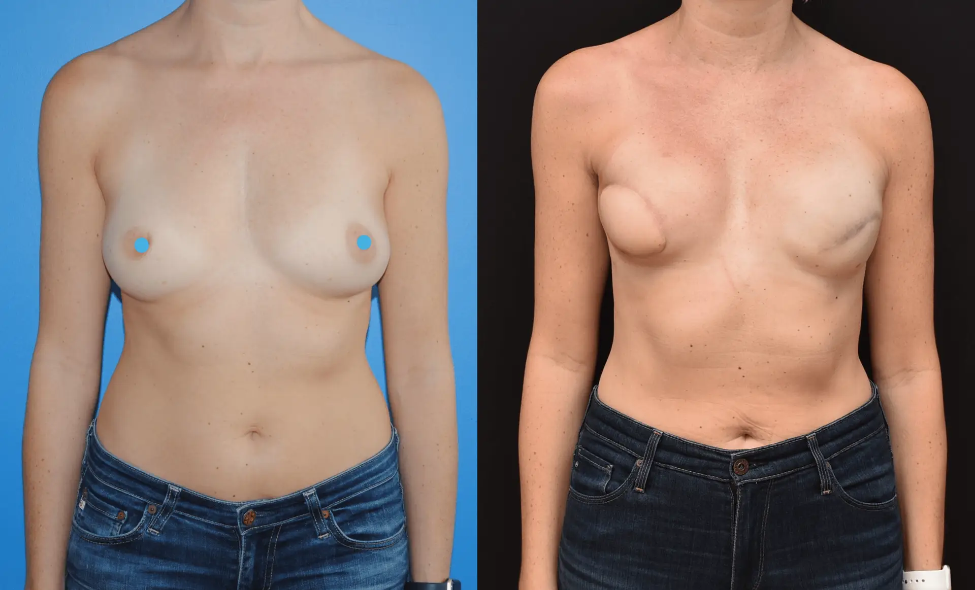 Latissimus Dorsi Myocutaneous Flap Recon