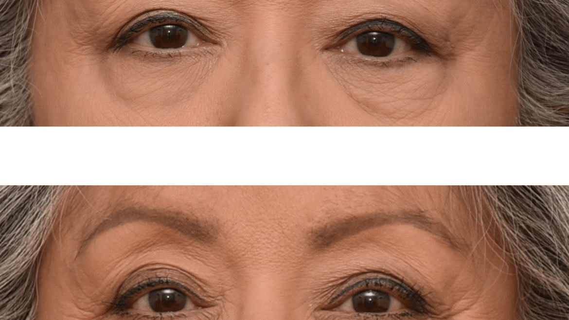 Blepharoplasty for Facial Rejuvenation
