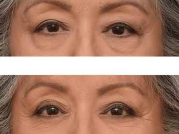 Blepharoplasty for Facial Rejuvenation