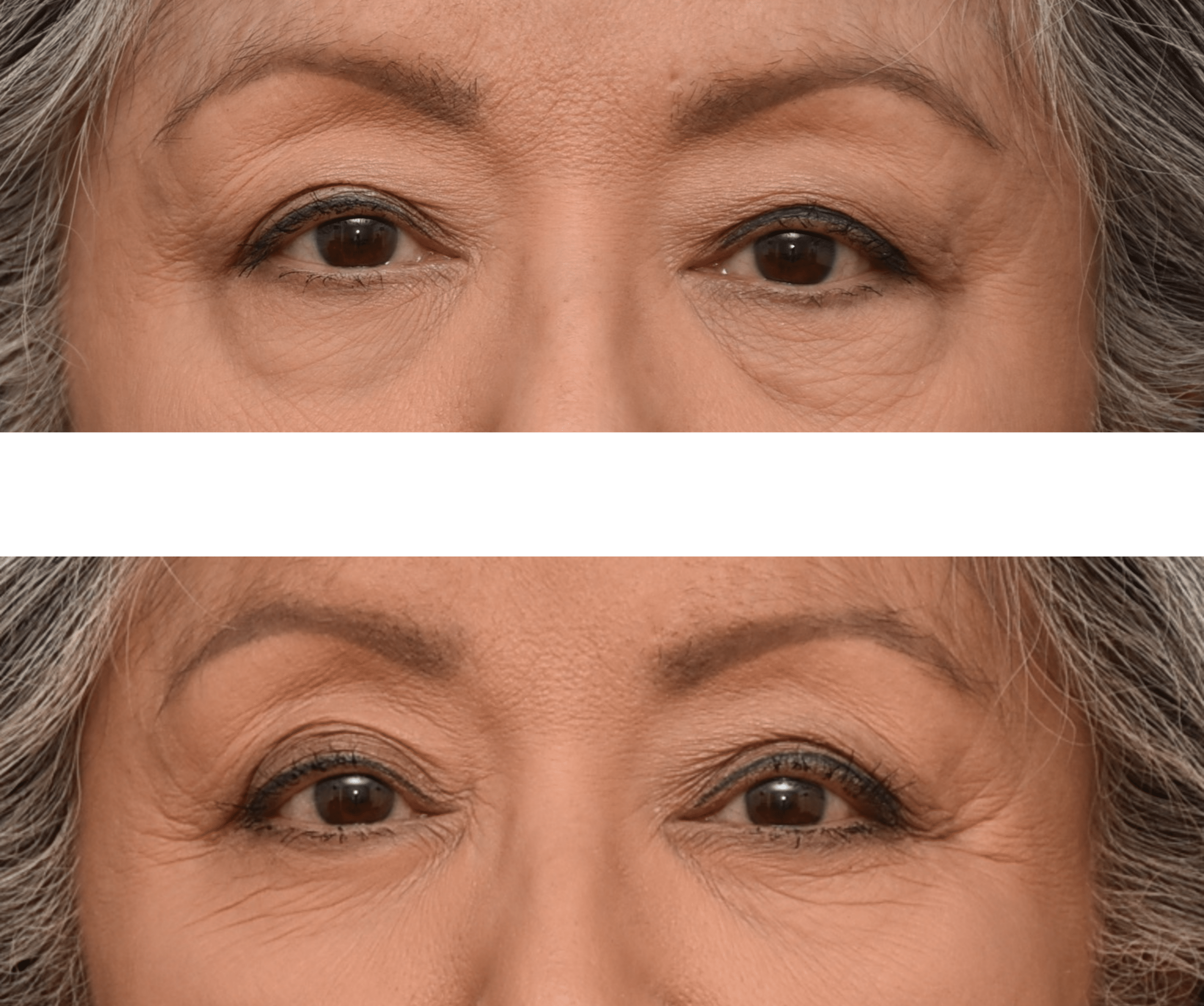 Blepharoplasty Surgery