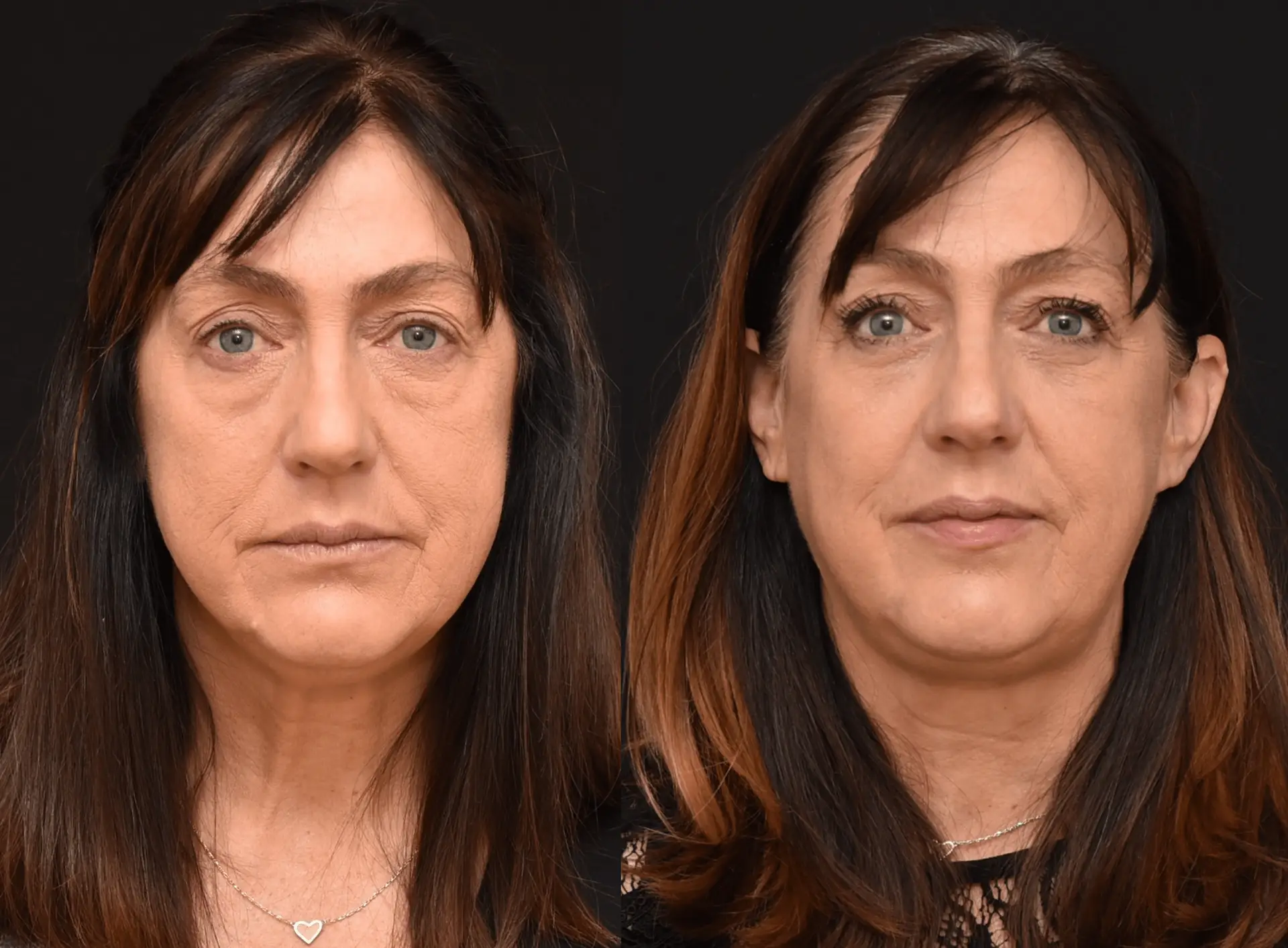 Lower Blepharoplasty