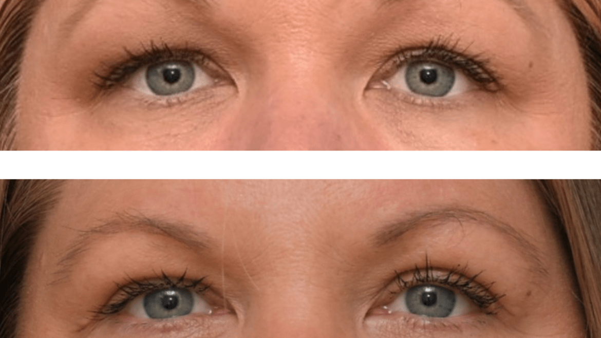 Blepharoplasty to Improve the Appearance of the Eyes