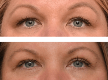 Blepharoplasty to Improve the Appearance of the Eyes