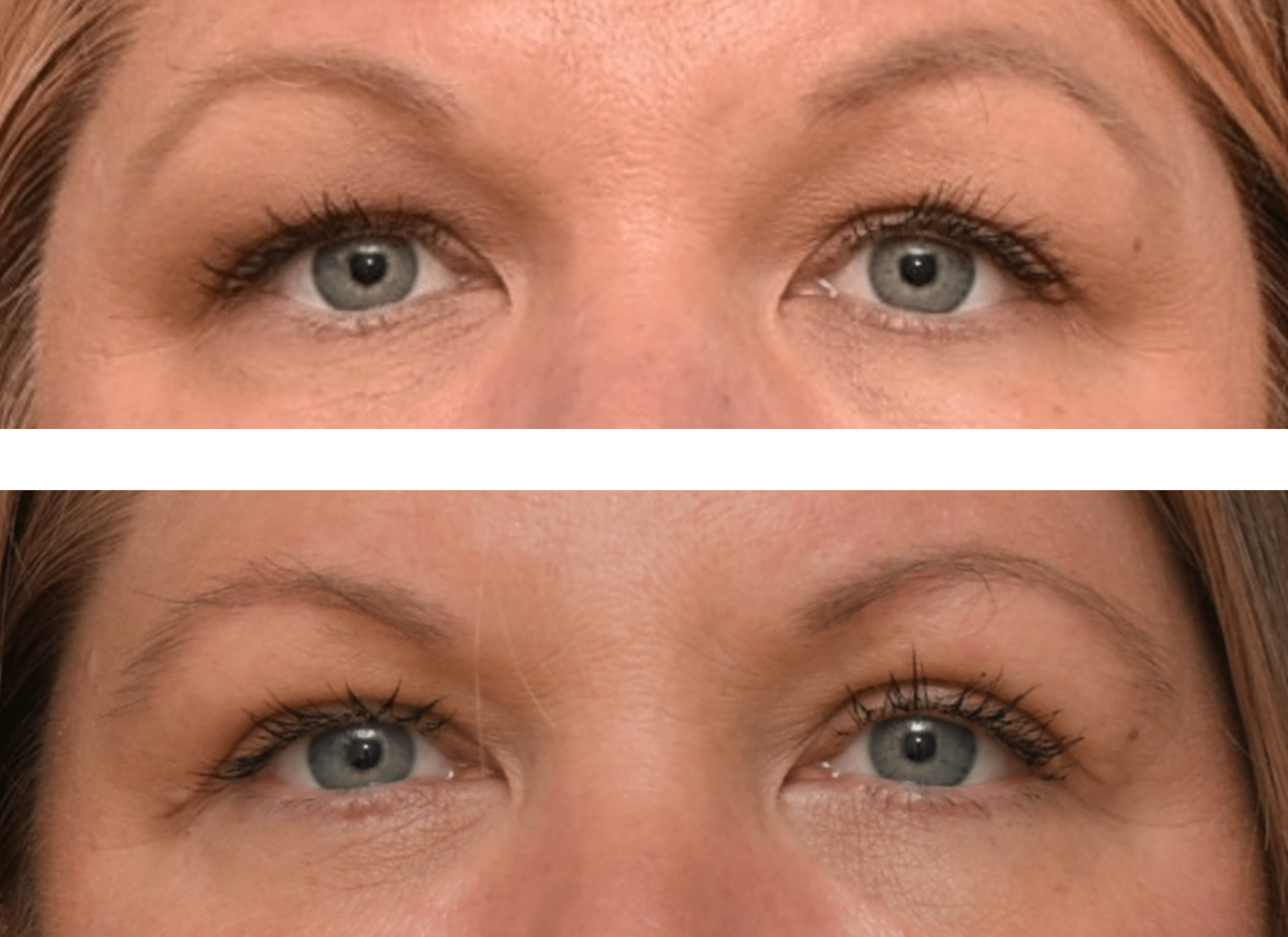 Upper Blepharoplasty